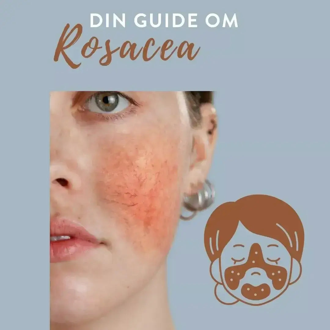 Din guide och tips om rosacea