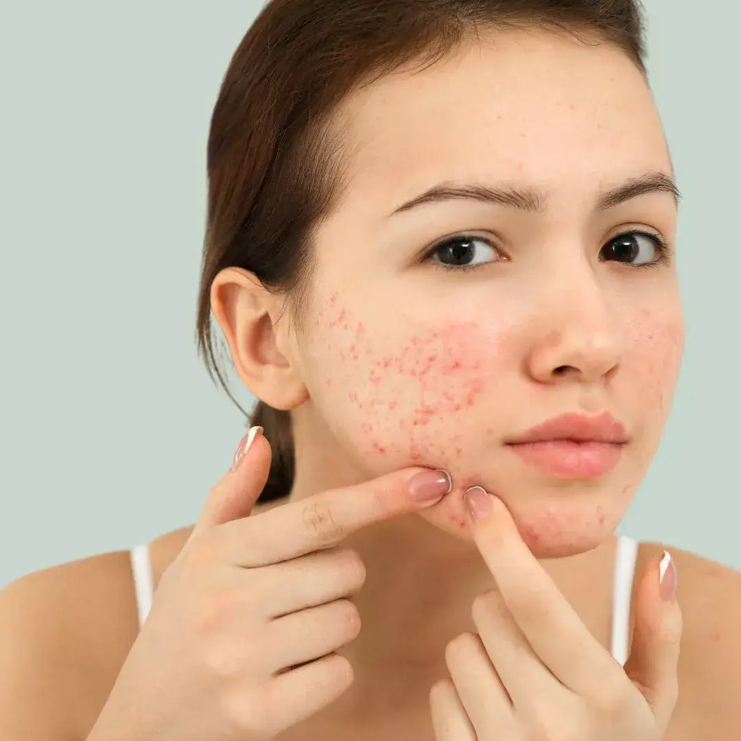 Flicka med fet hud och akne