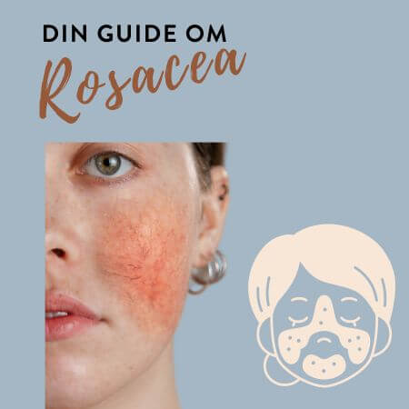 Rosacea  symtom och behandling - Din Guide!