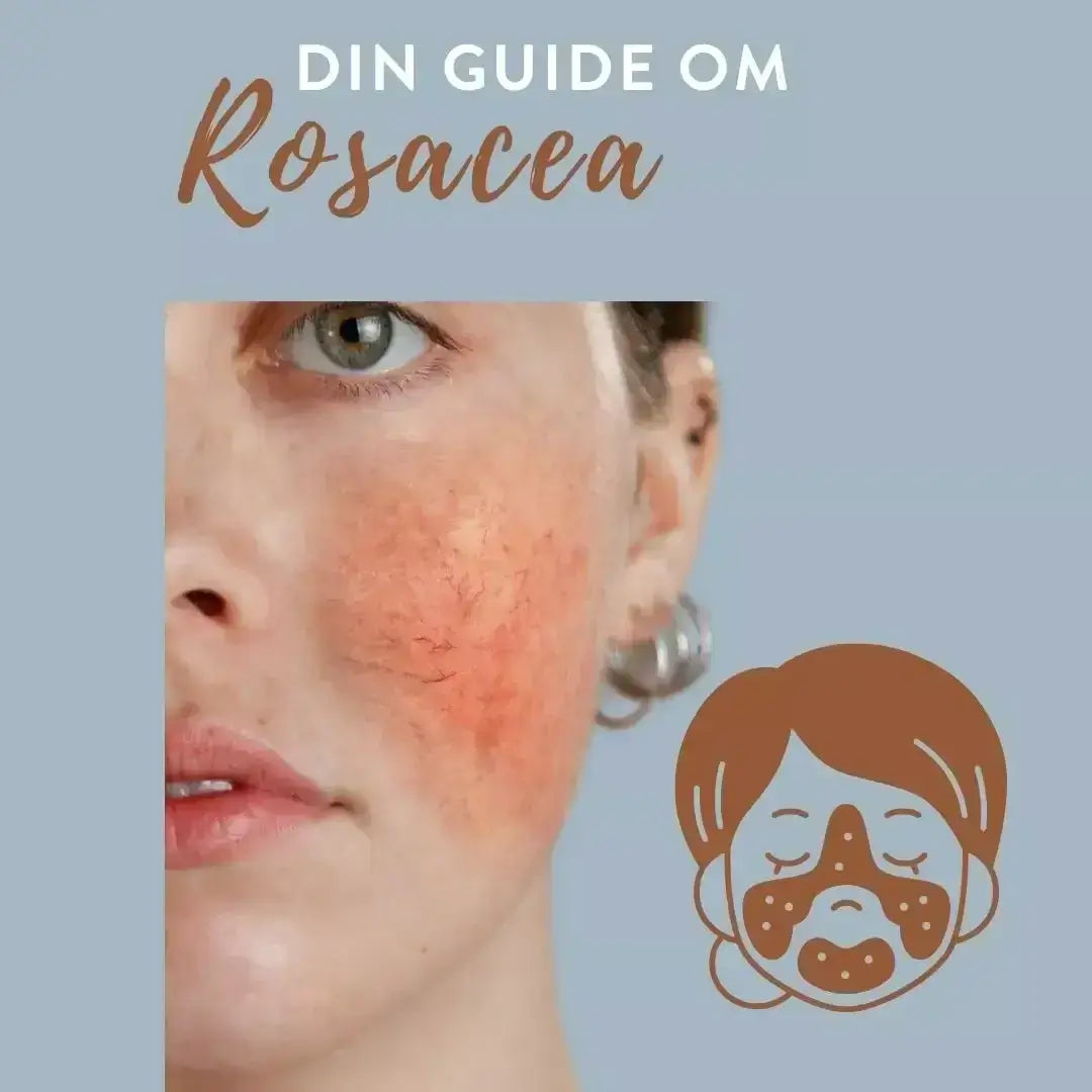 Din guide och tips om rosacea 
